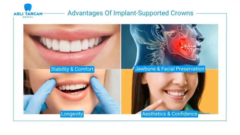Advantages Of Implant-Supported Crowns