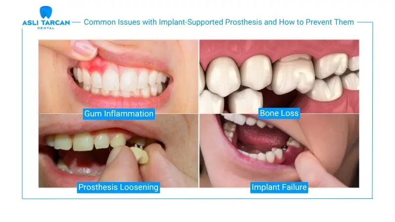 Common Issues with Implant-Supported Prosthesis and How to Prevent Them