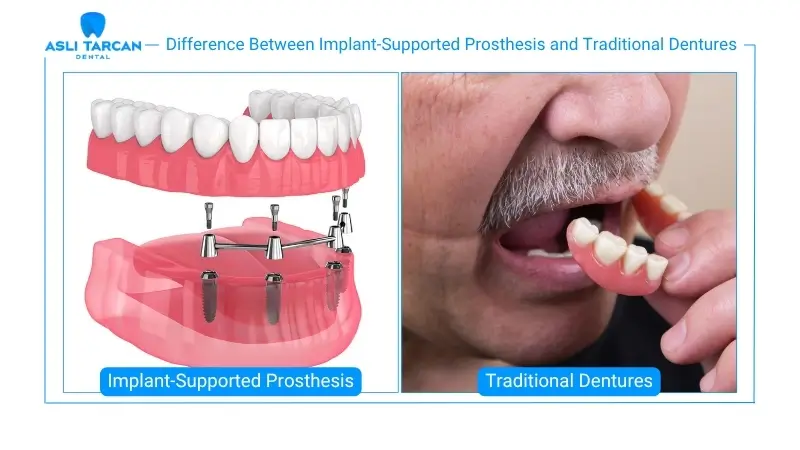 Difference Between Implant-Supported Prosthesis and Traditional Dentures