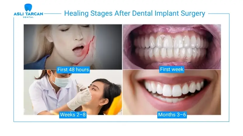 Healing Stages After Dental Implant Surgery