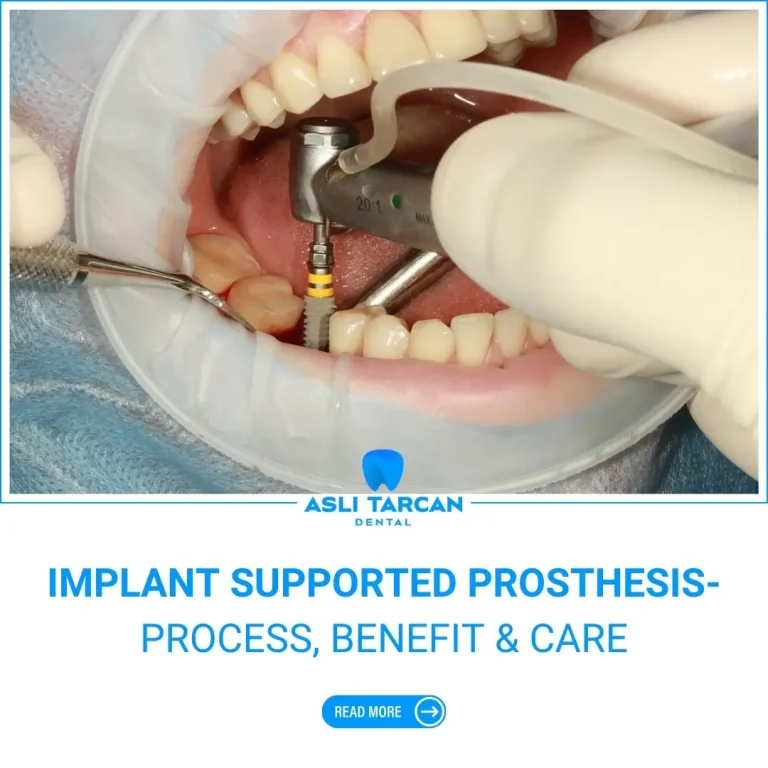 Implant Supported Prosthesis- Process, Benefit & Care
