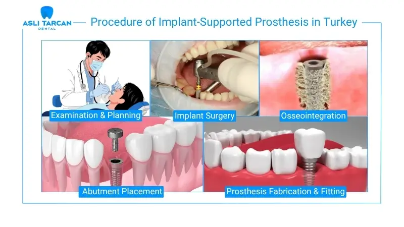 Procedure of Implant-Supported Prosthesis in Turkey