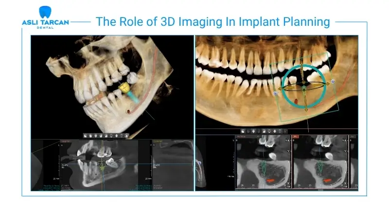 The Role of 3D Imaging In Implant Planning
