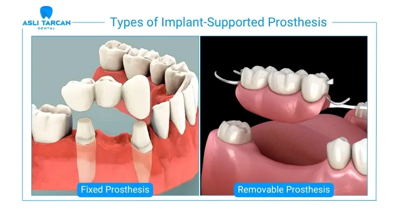 Types of Implant-Supported Prosthesis