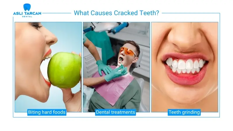 What Causes Cracked Teeth