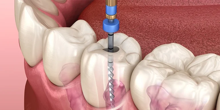 canal treatment