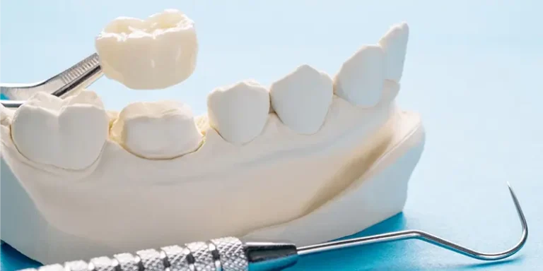 dental crowns