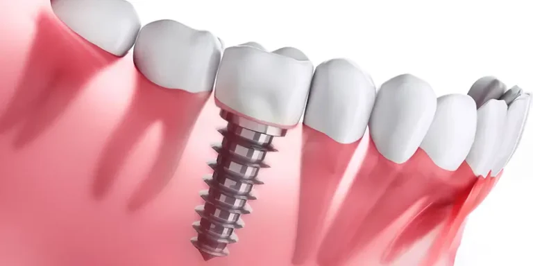 dental implants