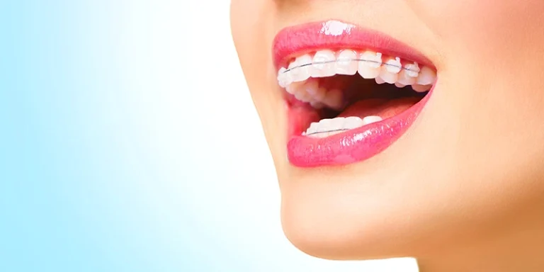 orthodontic treatment
