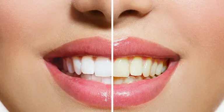 teeth whitening turkey