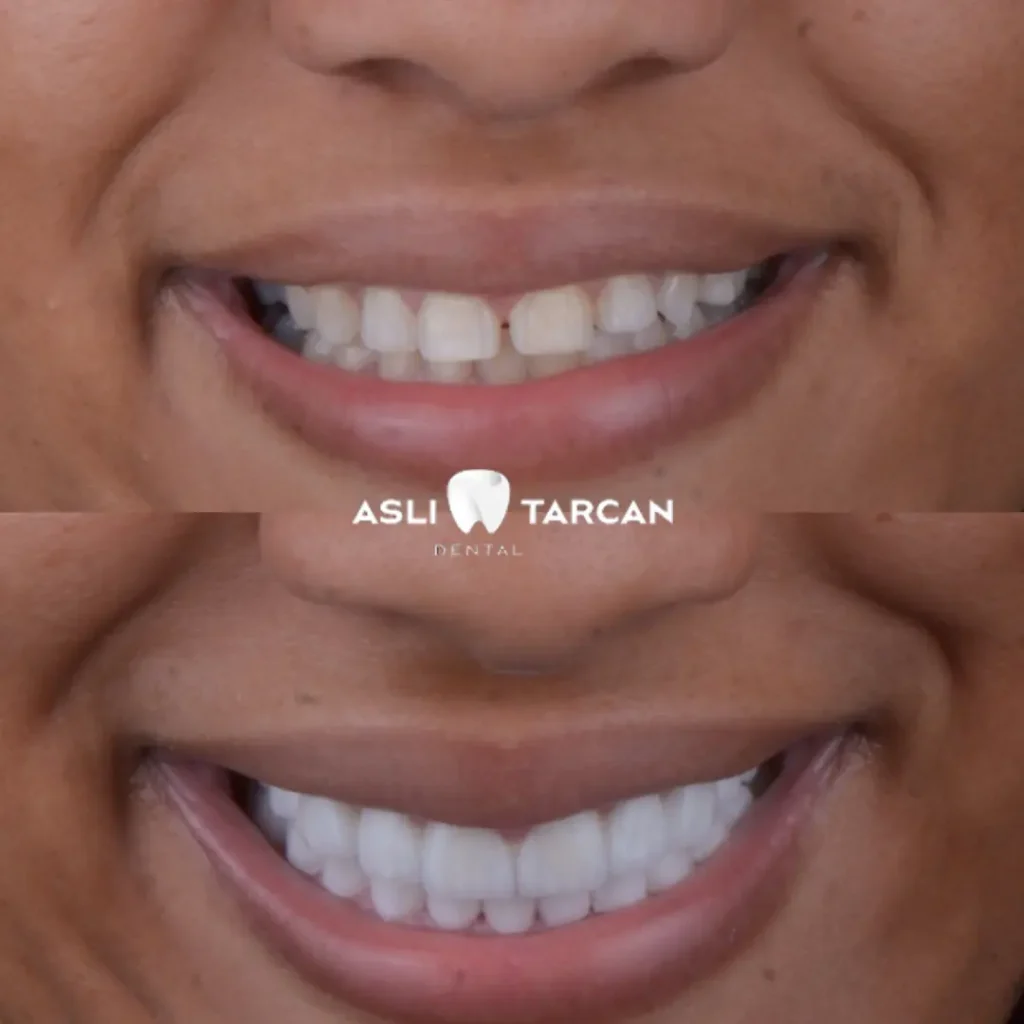 Dental Crown Patient 2