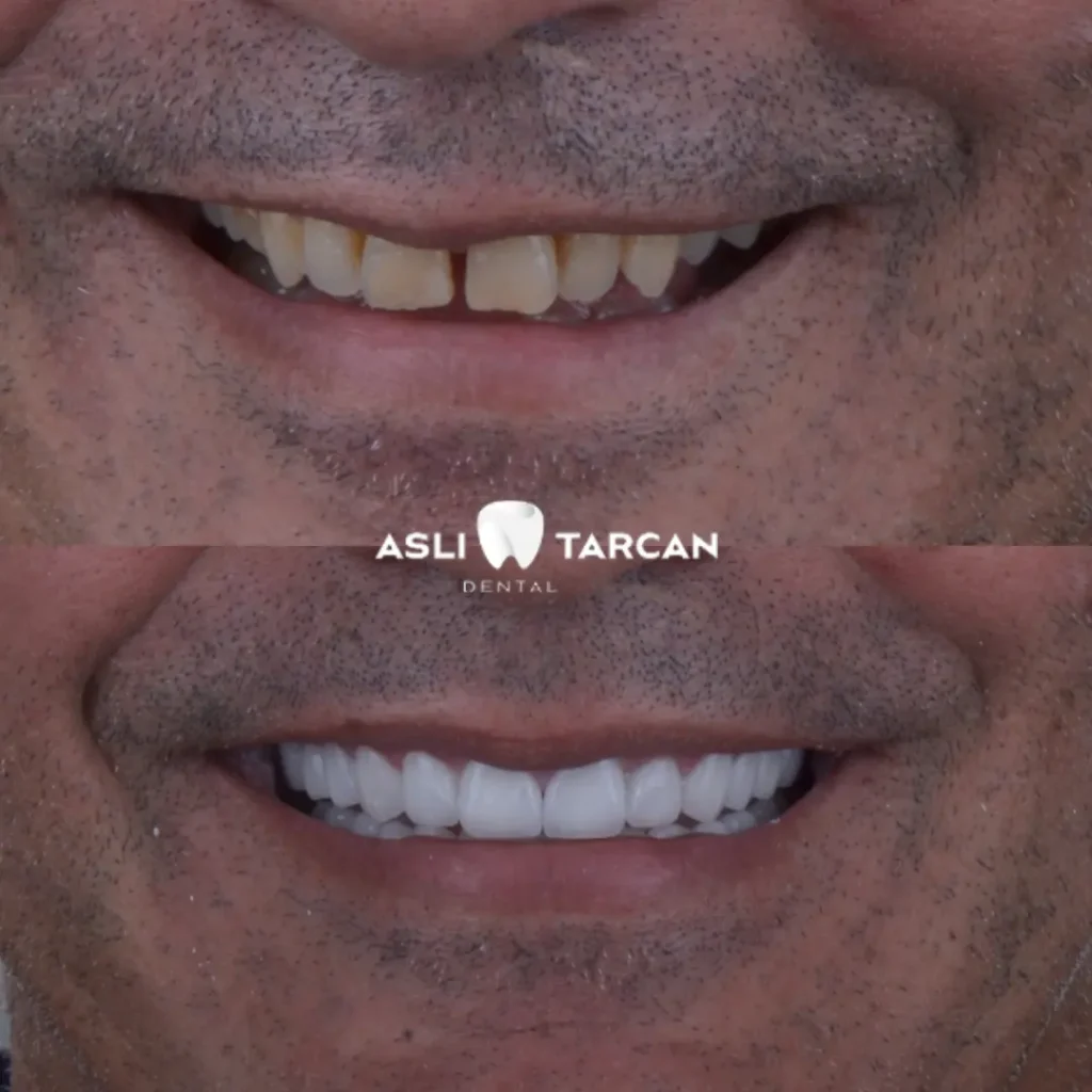 Dental Crown Patient 3