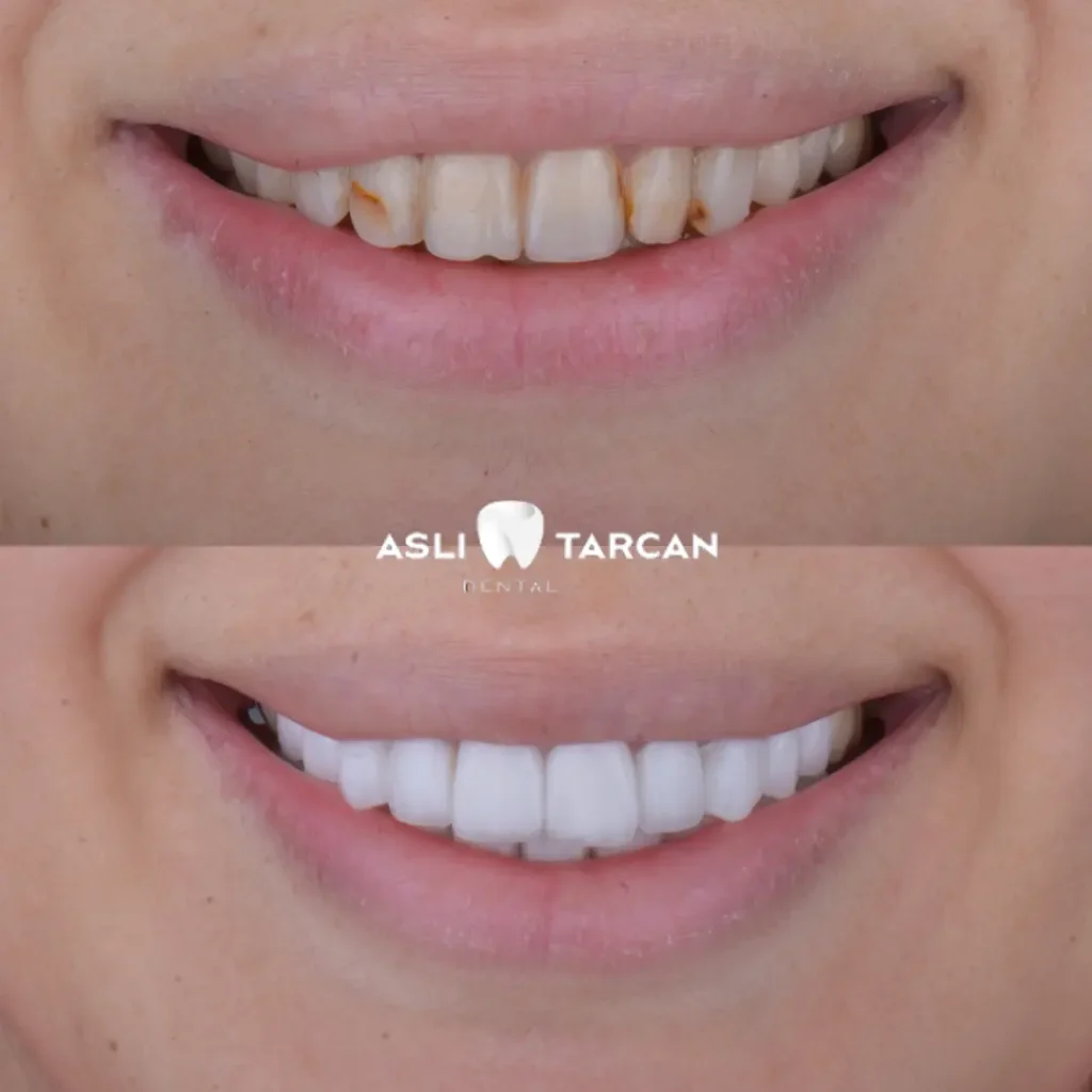 Dental Crown Patient 4