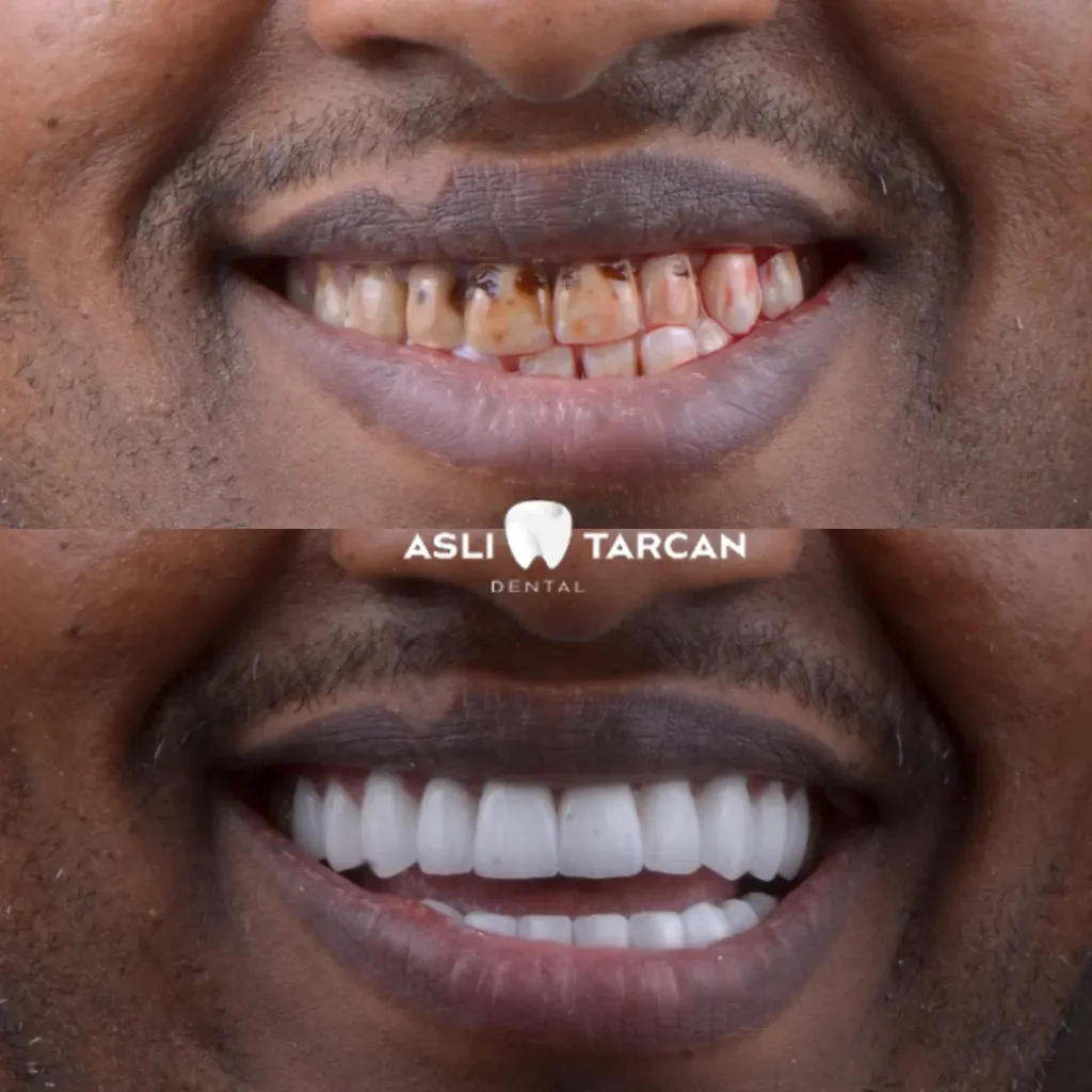 Dental Crowns Patient 1