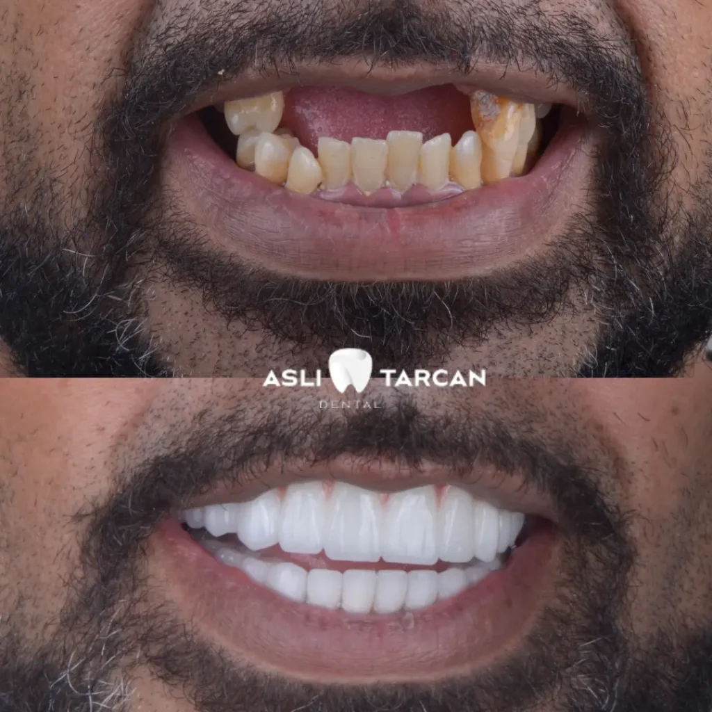 Dental Implant Patient 1
