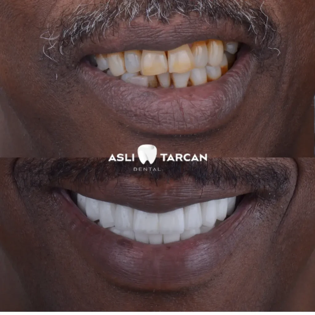 Dental Implant Patient 2