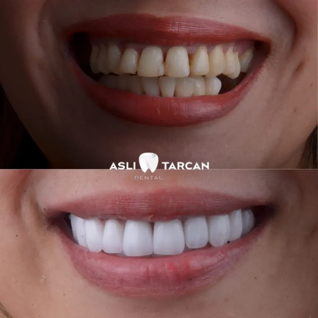 Dental Implant Patient 2