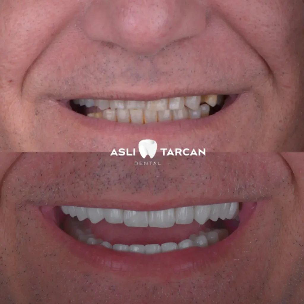 Dental Implant Patient 3