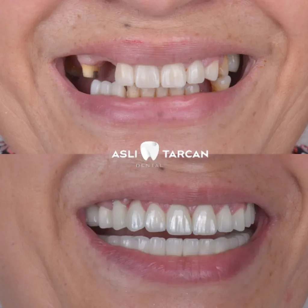 Dental Implant Patient 4