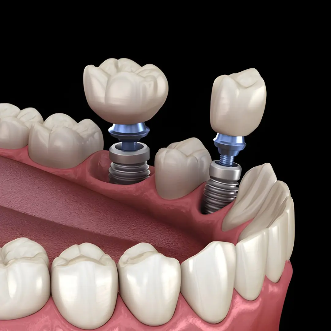Dental Implant Visual Example