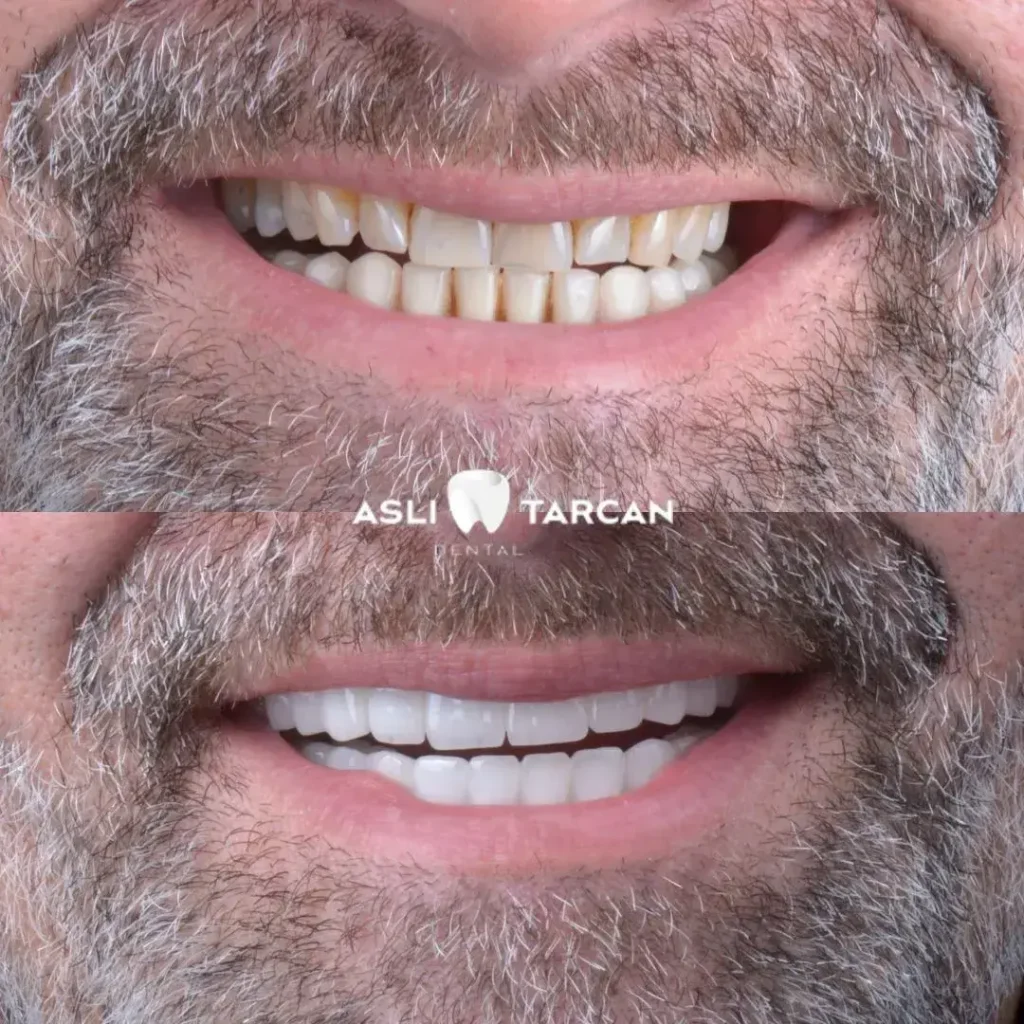 Dental Veneers Patient 1