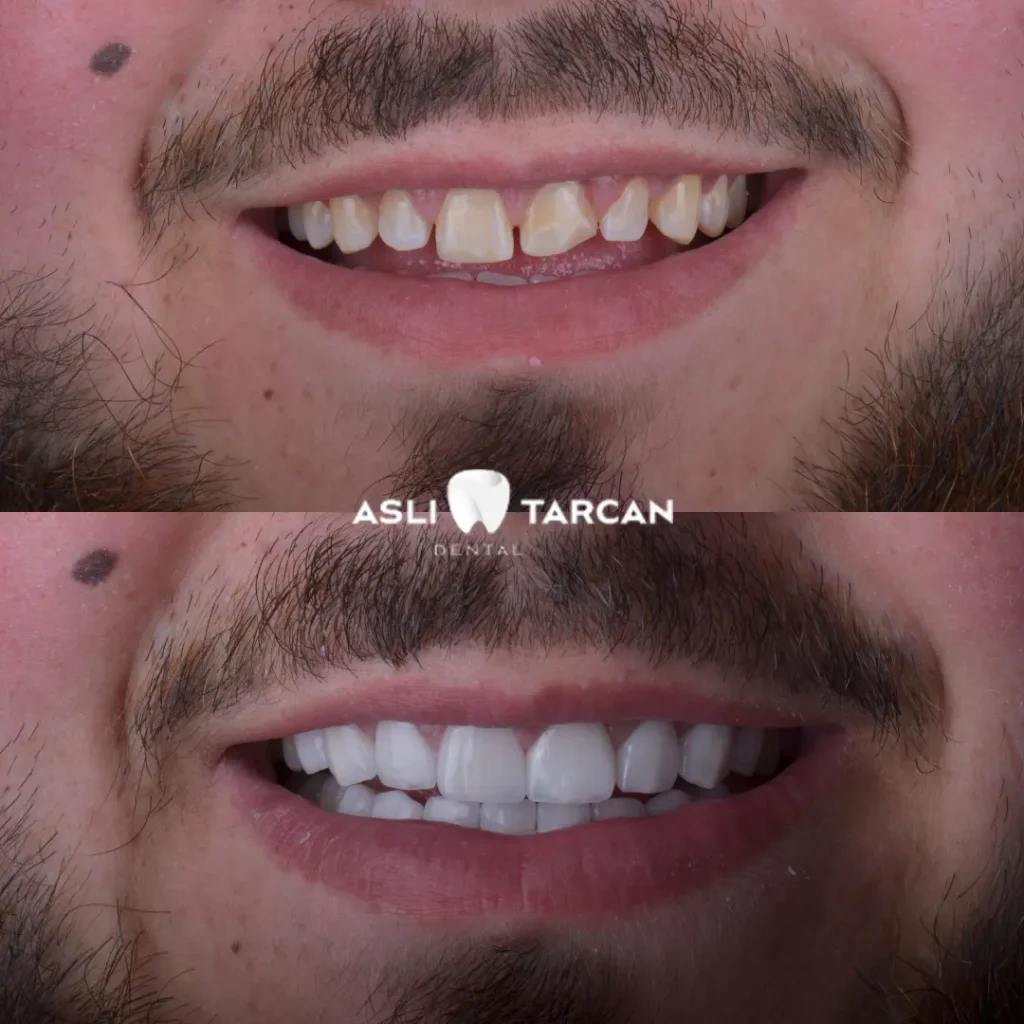 Dental Veneers Patient 3