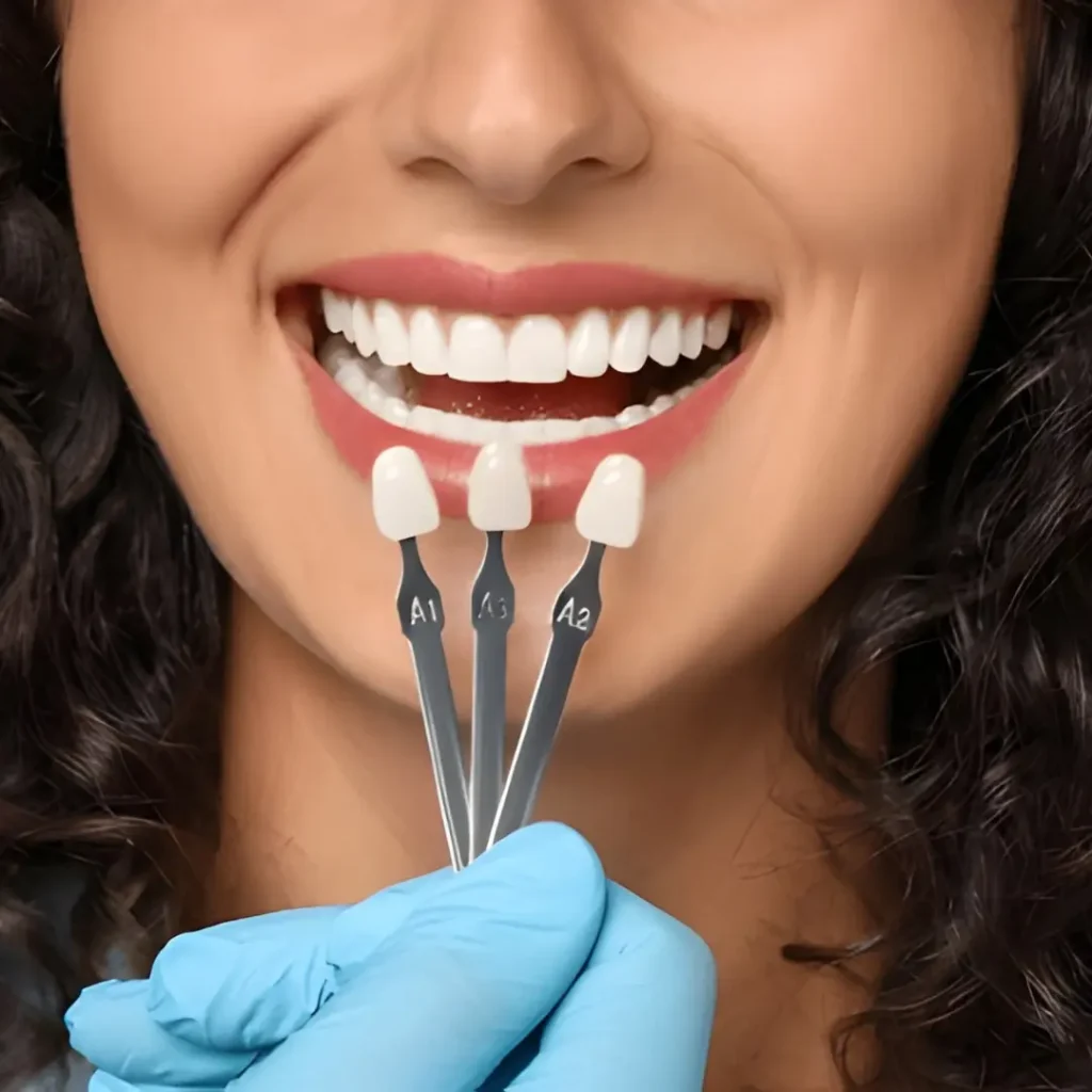 Example Image of Dental Veneers