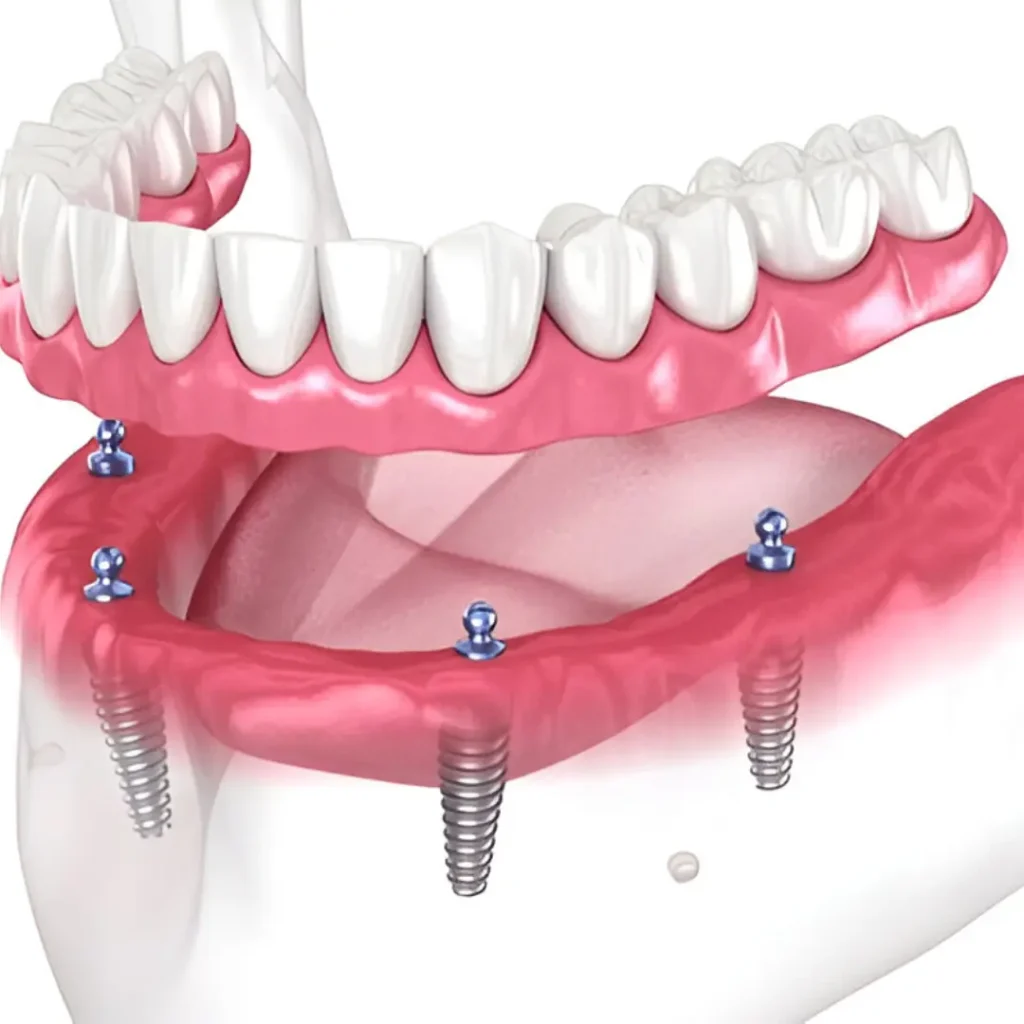 Example Image of Dentures