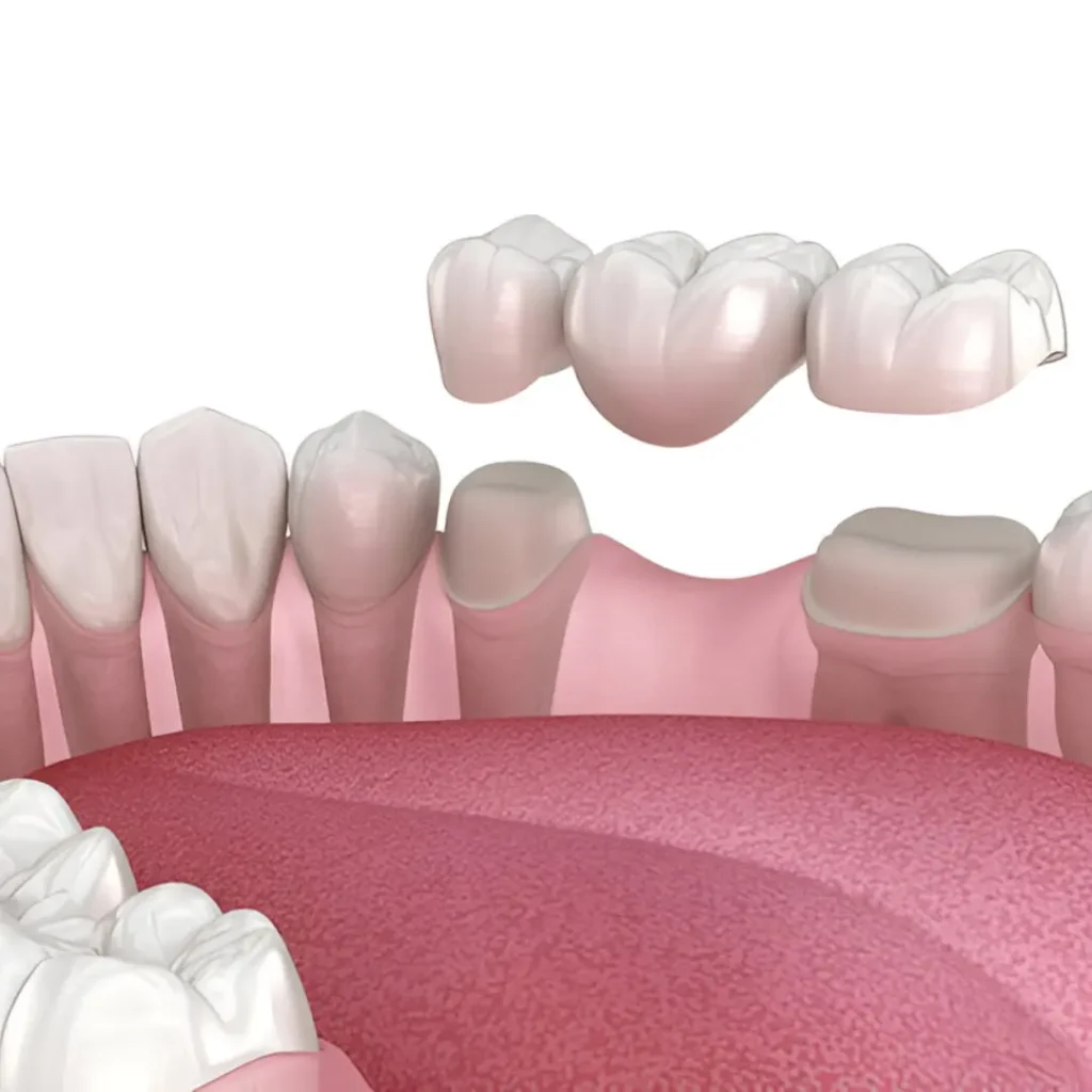 Example image of Dental Bridge