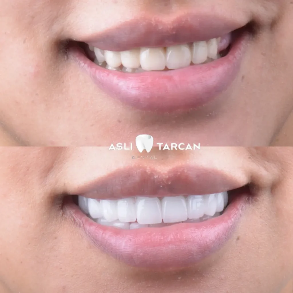 Hollywood Smile Patient 1