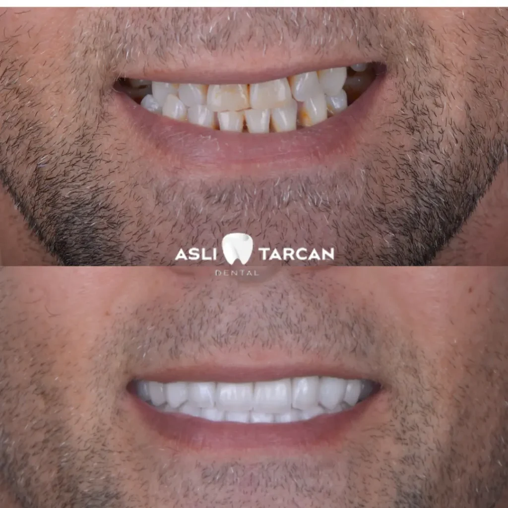 Hollywood Smile Patient 2