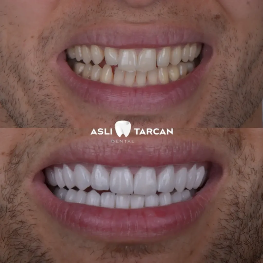 Hollywood Smile Patient 3