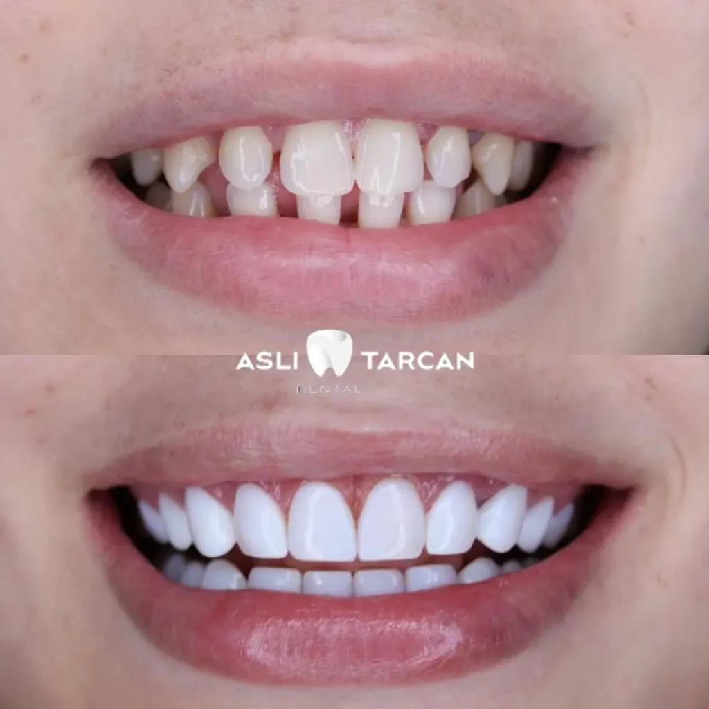 Laminate Veneer Patient 2