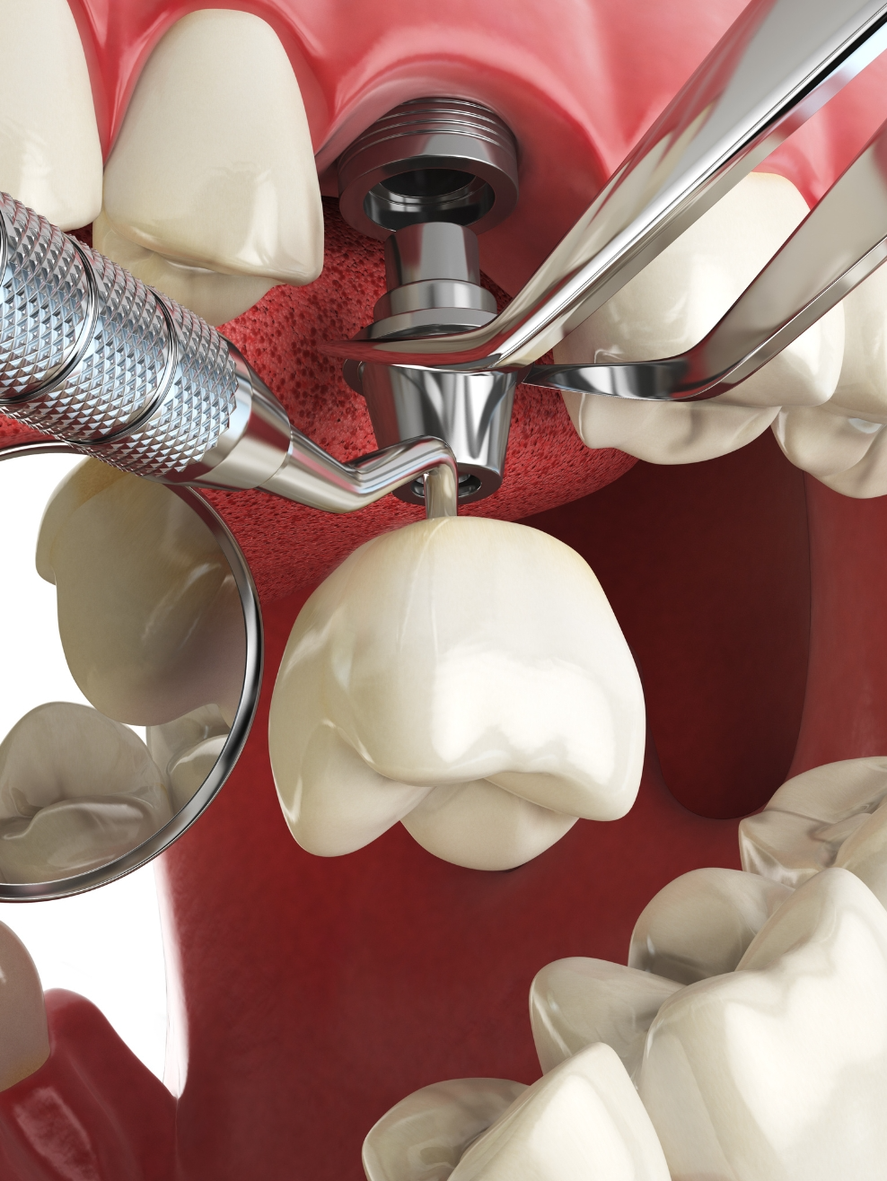 Advantages Of Sinus Lift Procedure