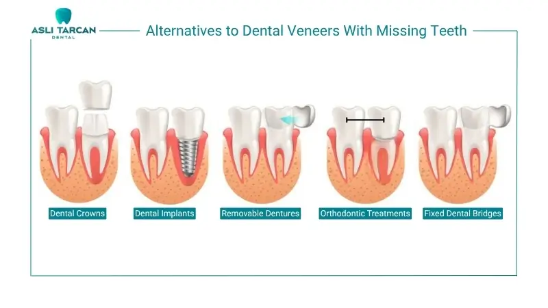 Alternatives to Dental Veneers With Missing Teeth