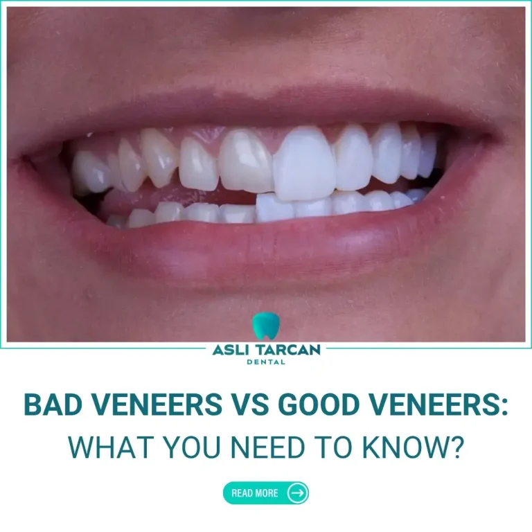 Bad Veneers vs Good Veneers What You Need to Know