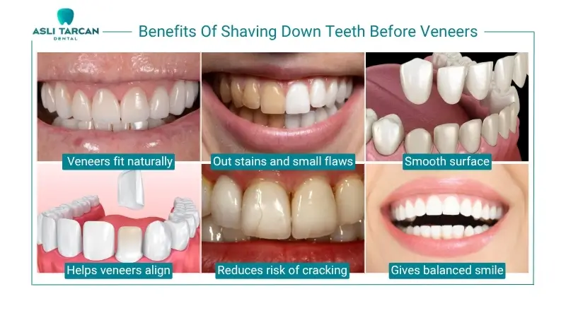 Benefits Of Shaving Down Teeth Before Veneers