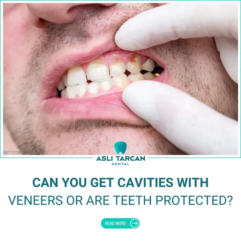 Can You Get Cavities With Veneers or Are Teeth Protected