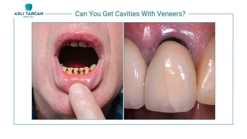 Can You Get Cavities With Veneers