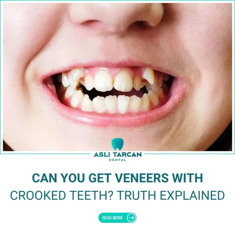 Can You Get Veneers With Crooked Teeth
