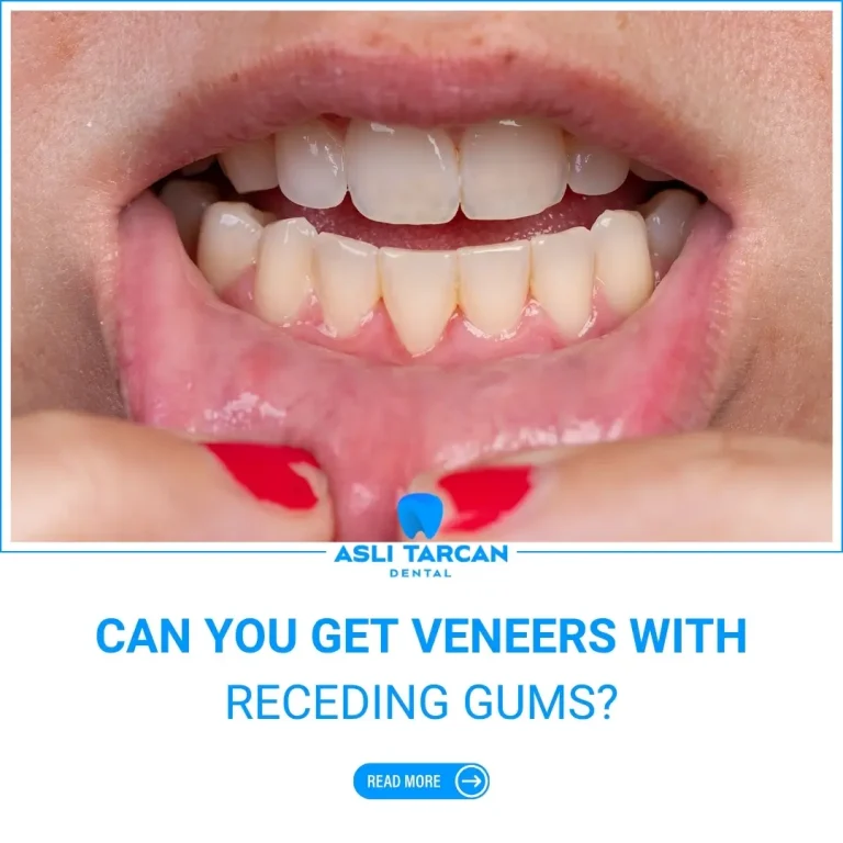 Can You Get Veneers With Receding Gums