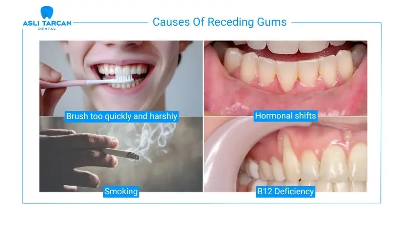 Causes Of Receding Gums