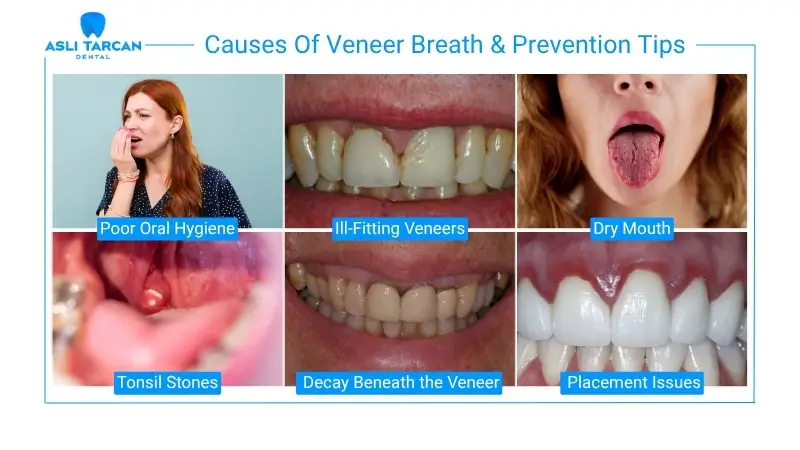 Causes Of Veneer Breath & Prevention Tips