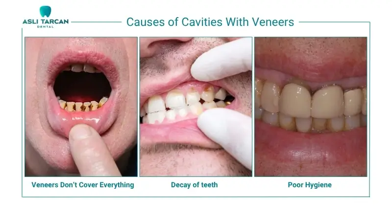 Causes of Cavities With Veneers