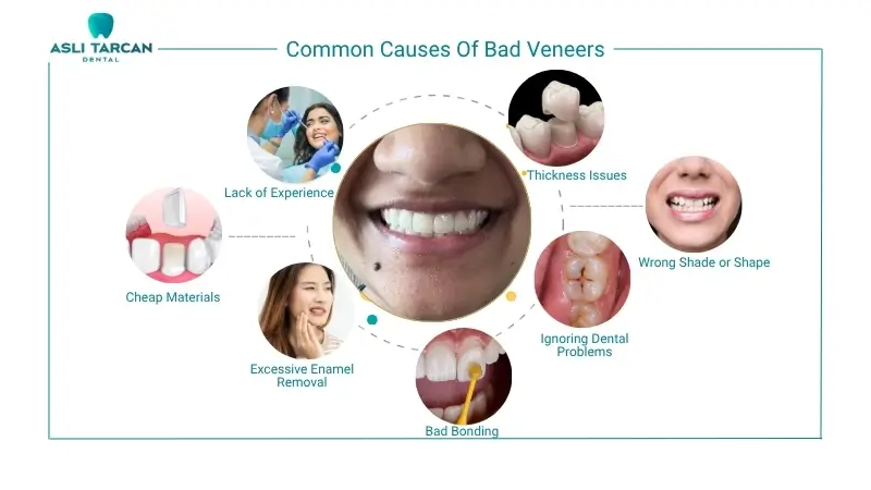 Common Causes Of Bad Veneers