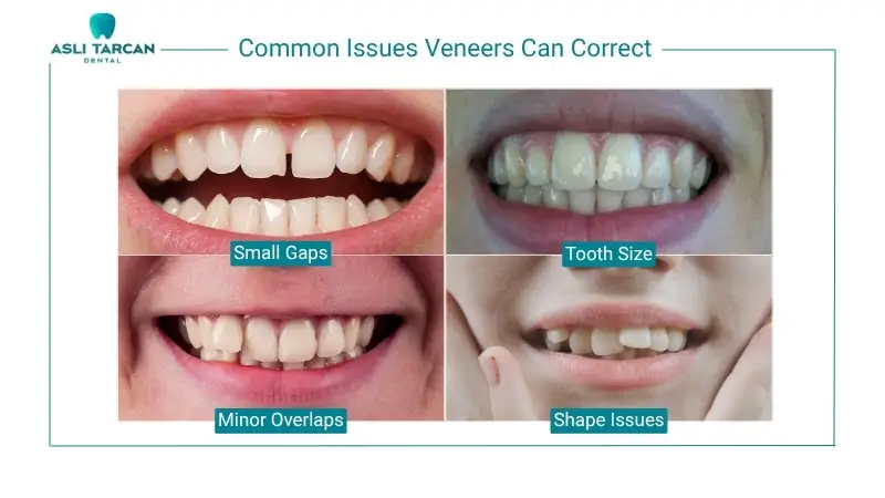 Common Issues Veneers Can Correct