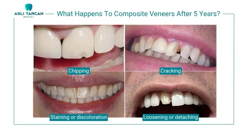 Composite Veneers After 5 Years