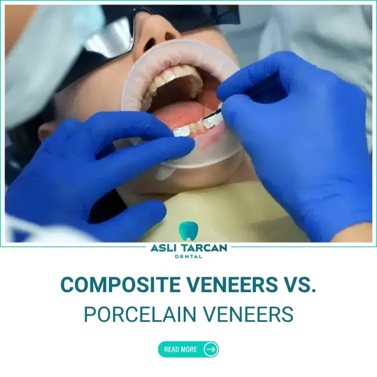 Composite Veneers Vs. Porcelain Veneers