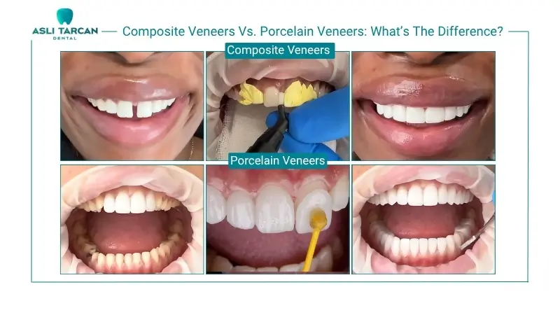 Composite Veneers Vs. Porcelain Veneers What’s The Difference
