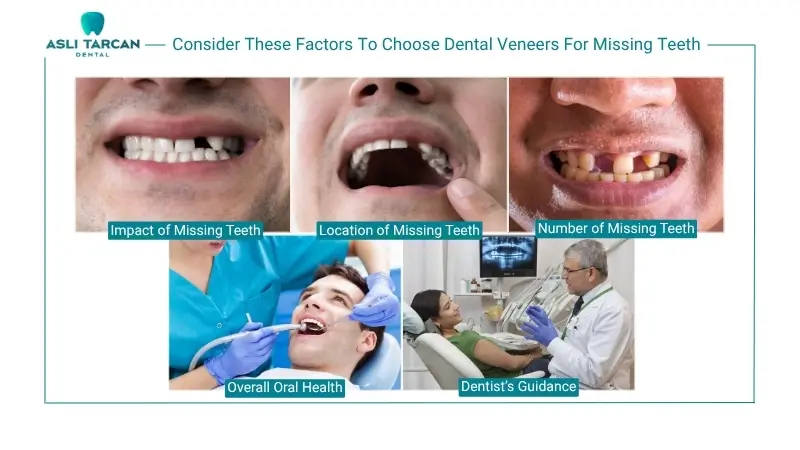 Consider These Factors To Choose Dental Veneers For Missing Teeth
